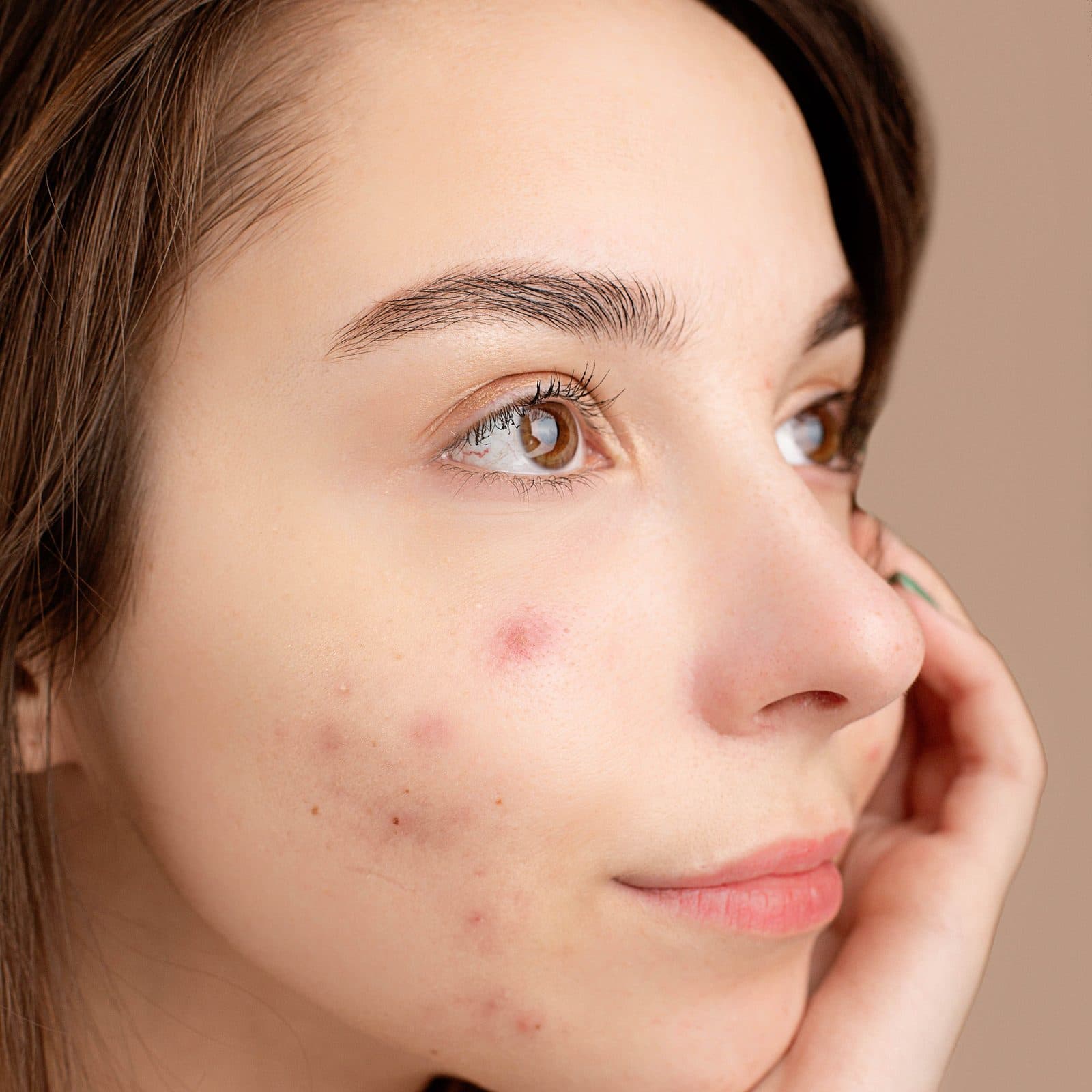Close up of a woman's cheek with active breakouts