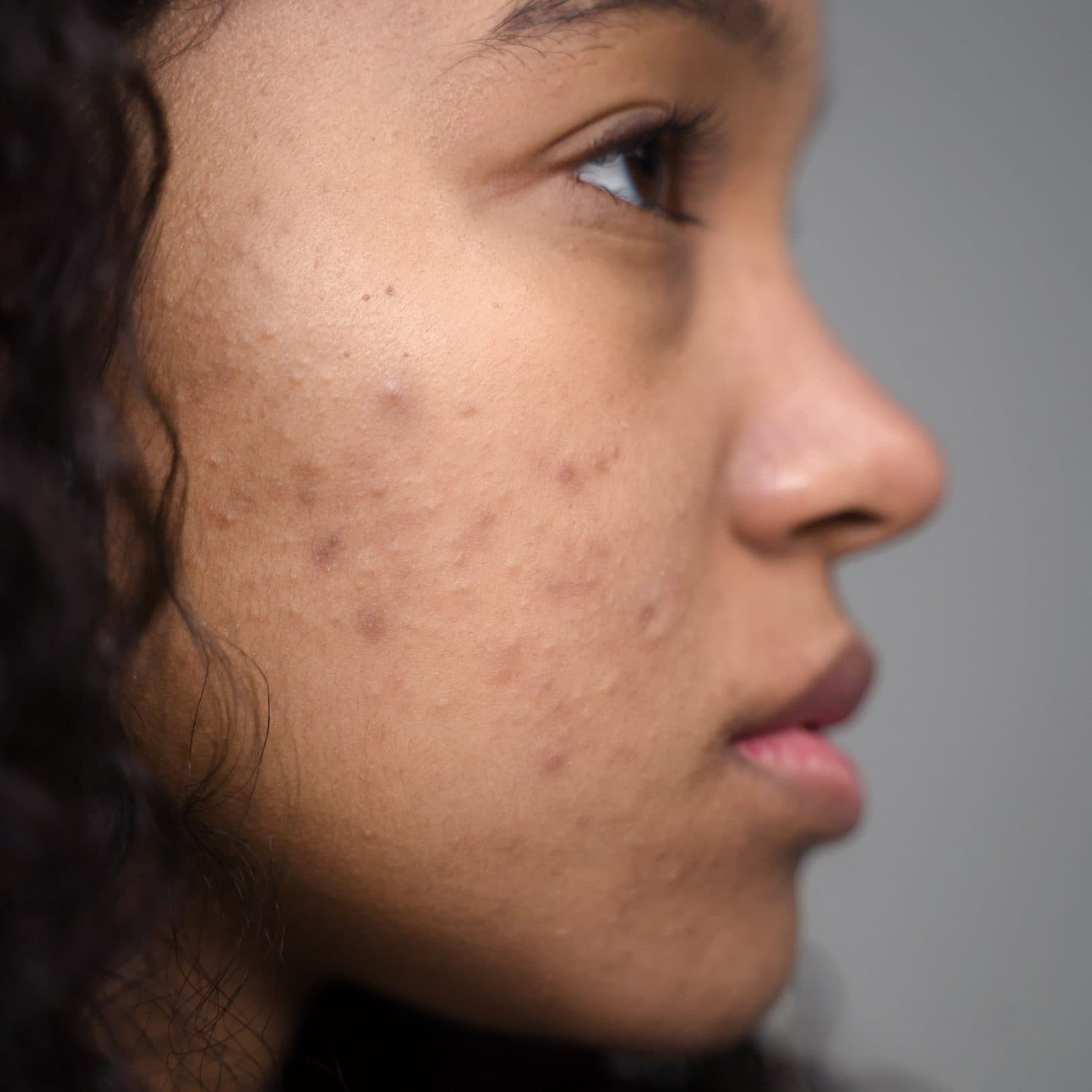 Side profile showing marks left on the cheek after acne