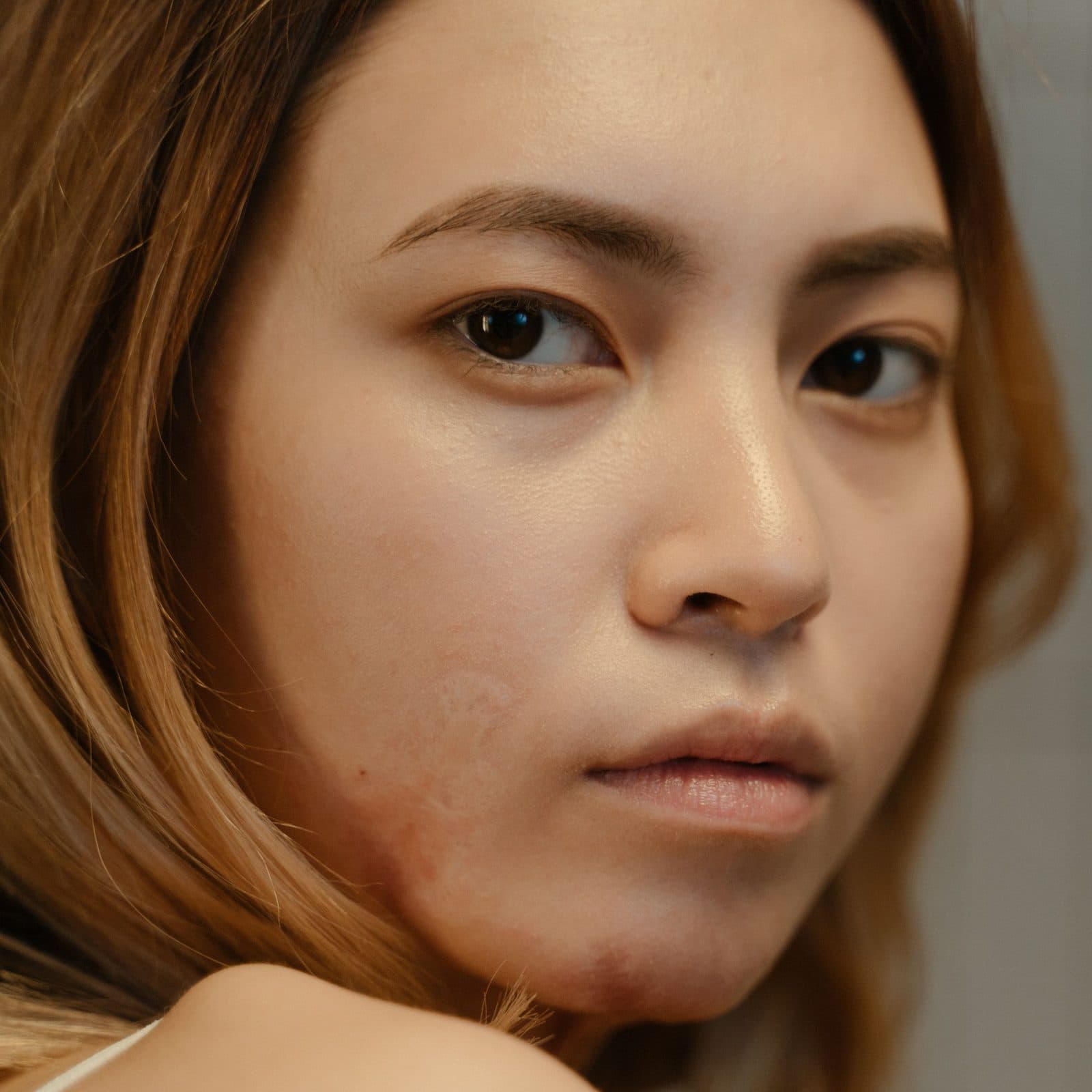 Close up of a woman's face with uneven pigmentation on the cheeks